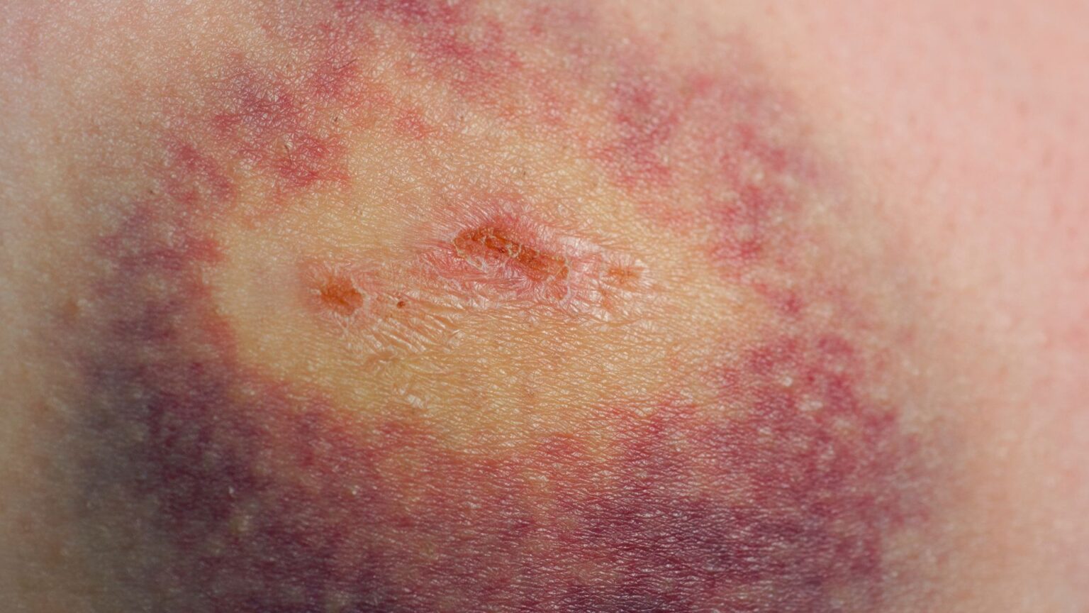 Understanding Why You Bruise Easily And The Dangers Involved MyCLNQ Health